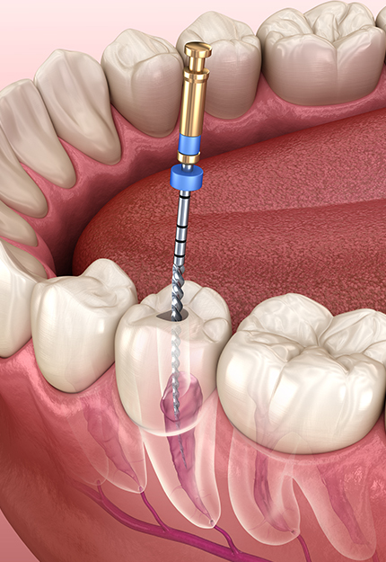 MIDAMEUN 자연치아 살리기
